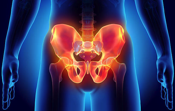 Ilustración de cáncer de pelvis