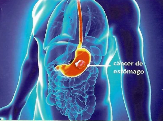 Ilustración de cáncer gástrico