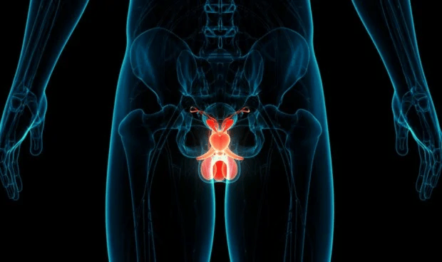 Ilustración de cáncer de próstata