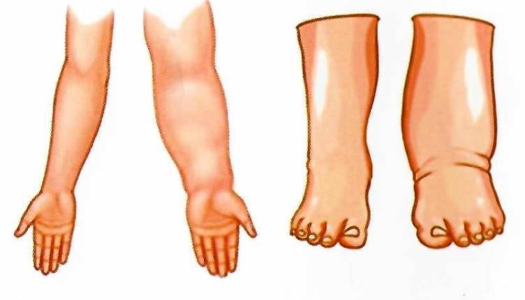 Imagen de linfedema en brazo